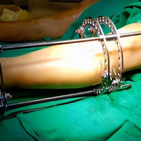 断骨增高术死灰复燃引热议，120+用户观点全景剖析：拿健康赌身高值不值？