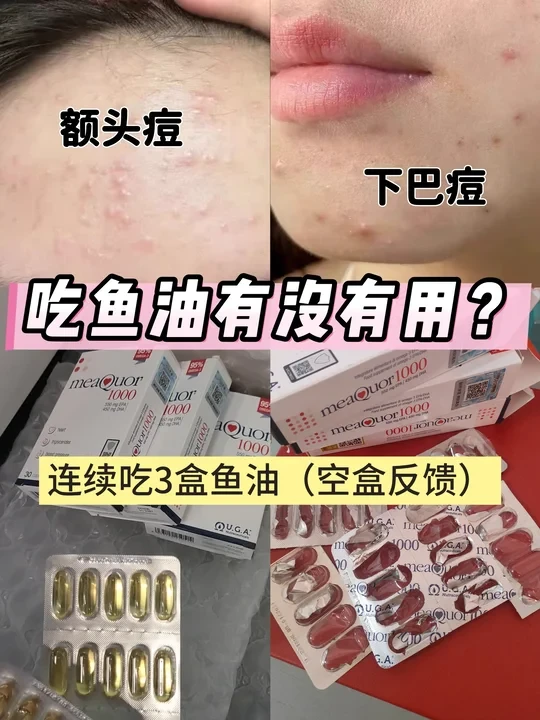 （下巴痘额头痘）吃完3盒金凯撒鱼油