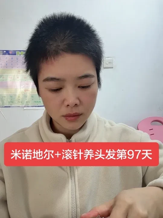 米诺地尔➕滚针养头发，效果真的很好。三个多月了，坚持真的有意义。我的养发四件套，米诺，滚针，上药器，按摩梳。#米诺地尔搽剂