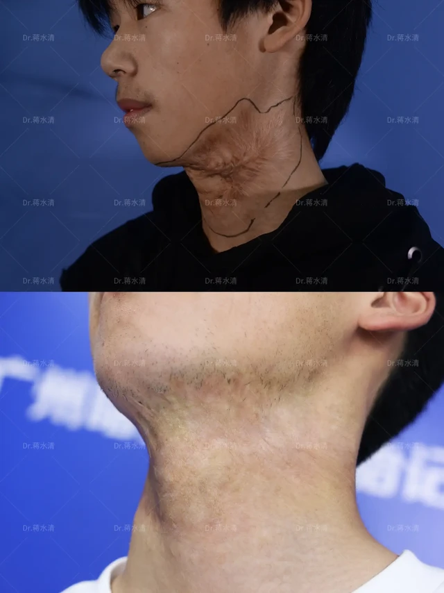 大面积脖颈烧烫伤疤痕，修复到了理想状态！