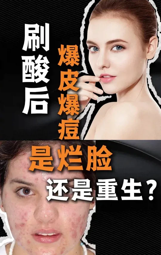 刷酸后爆皮爆痘是烂脸还是重生？
#医疗健康创作训练营
#抖出健康知识宝藏
#我的年度健康盘点