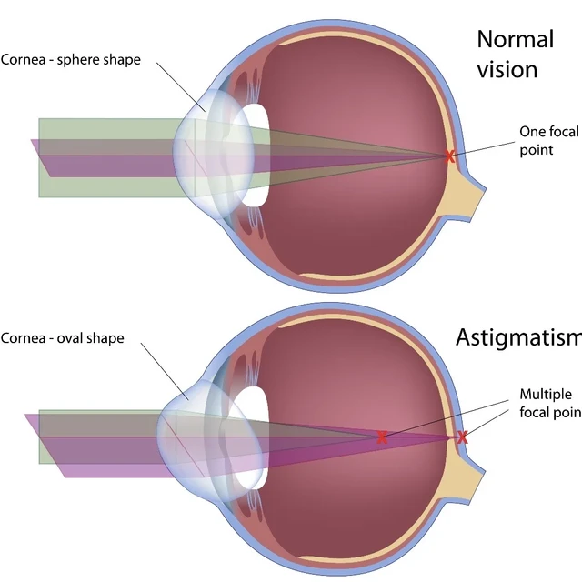 为什么带散光隐形会觉得晕晕的