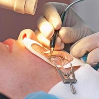 ICL 晶体植入恢复期多久？兰州人实测分享：24 小时就能摘镜炫！