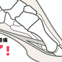 终于摆脱足底筋膜炎了！过来人的根除教程！轻松去除！