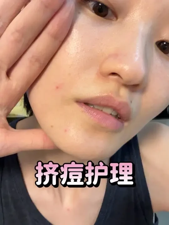 细节|挤痘破皮卫生护理#挤痘痘 #闭口 #油皮护肤 #爆痘 #痘肌护肤
