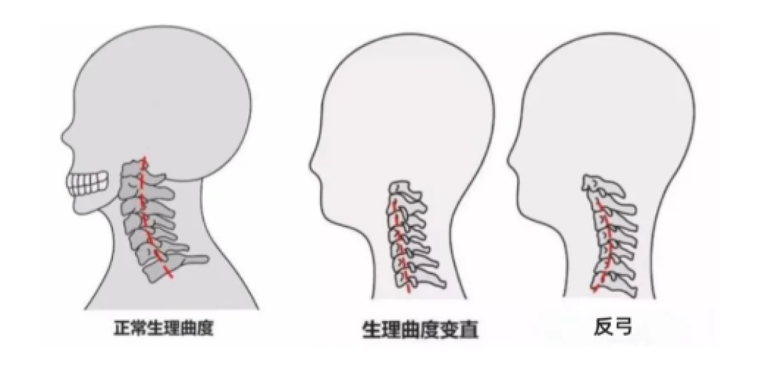 科学护颈:为什么不能随便按摩