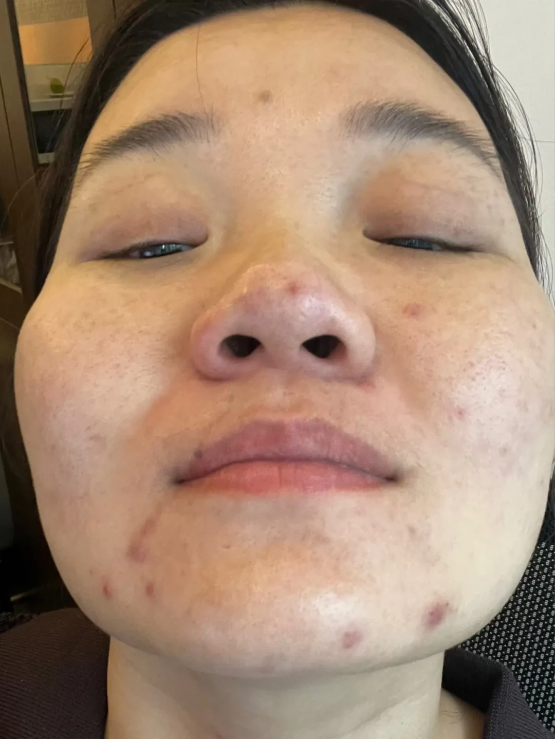 告别反复烂脸，这套抗炎护肤法值得尝试