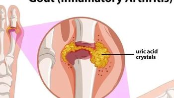 研究速递！原来这4种食物是降尿酸「高手」