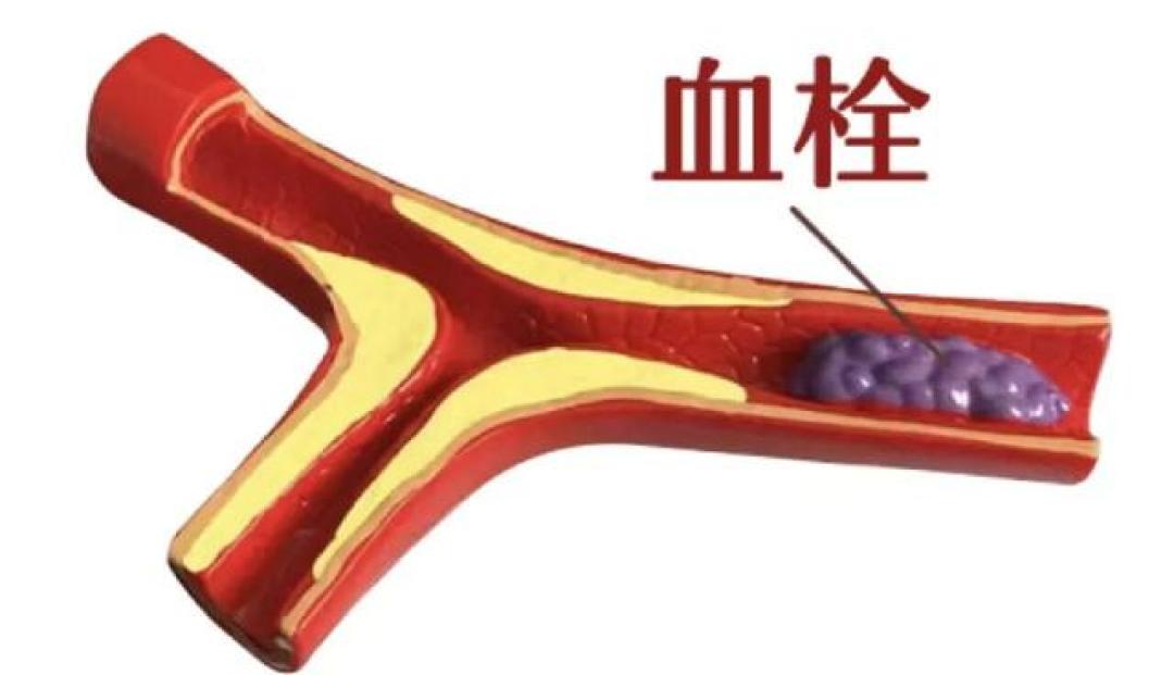 冬至护心法则:冠心病患者的饮食与行为禁忌