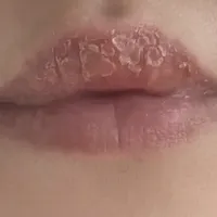 终结多年唇炎：关键在于修复屏障