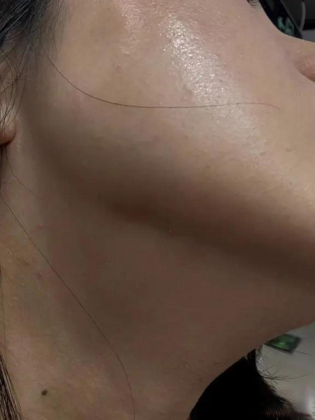 皮肤屏障修复实录:告别泛红,回归健康