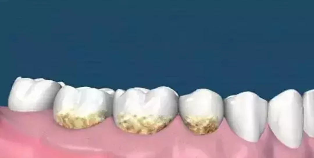 深度解析洗牙:从误区到正确护理的全指南