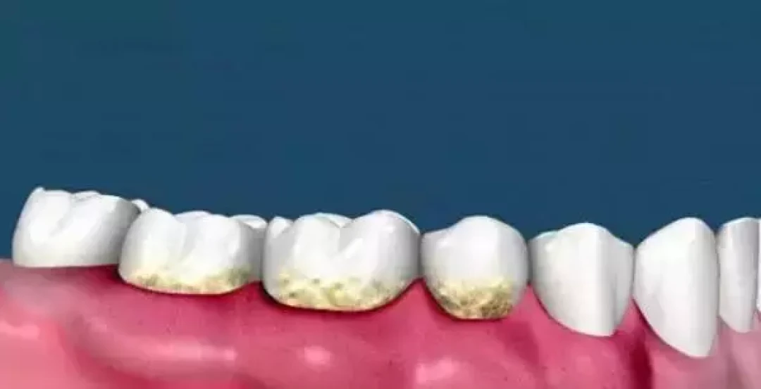 深度解析洗牙:从误区到正确护理的全指南