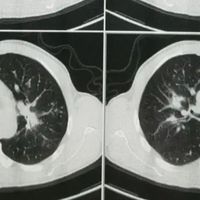 大扫除变“夺命扫除”？73岁大爷扫房扫进ICU！！！