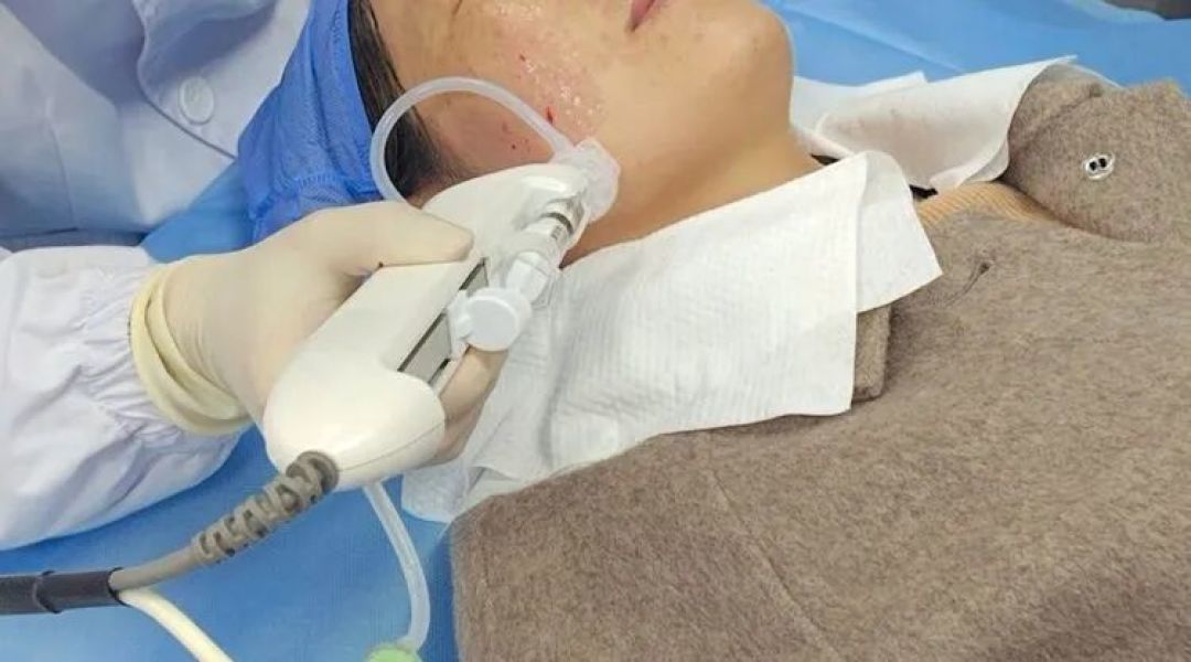 科普|男士医美四大实用项目