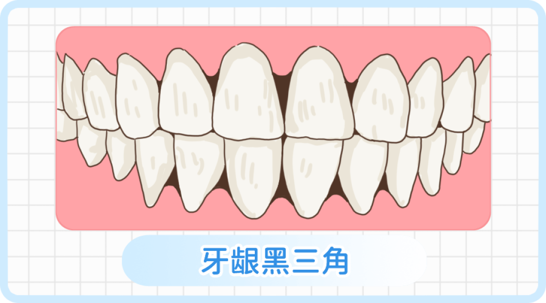 吃饭老塞牙的人,你的牙齿正在喊救命!10个妈妈8个中招