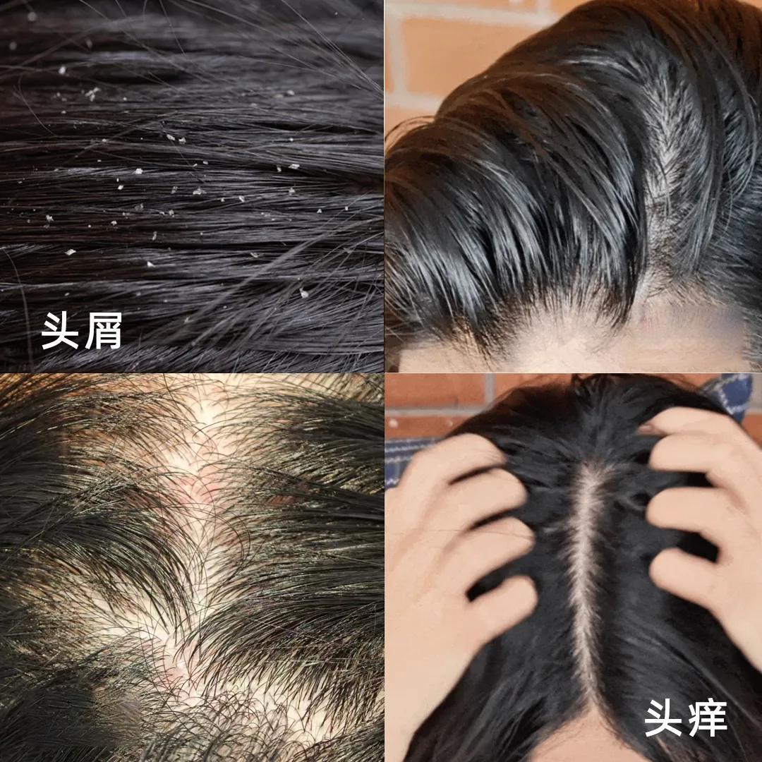 春天头痒、夏天扁塌、秋天掉发、冬天长屑？小心是洗发水害你！