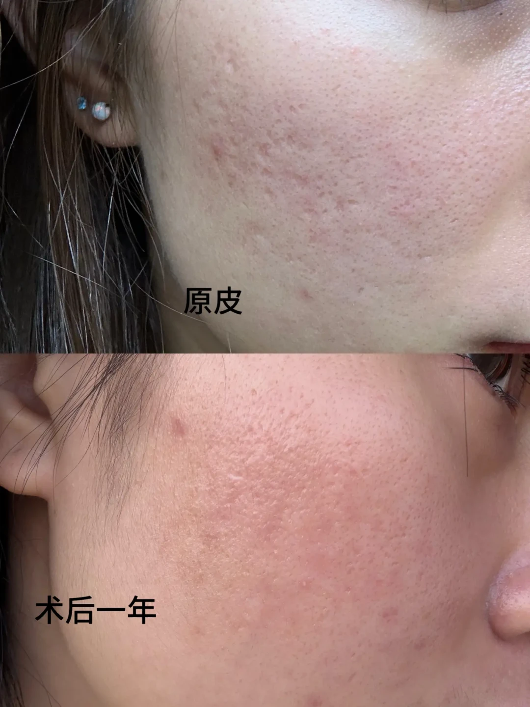 时隔一年皮下分离和皮下填充恢复分享