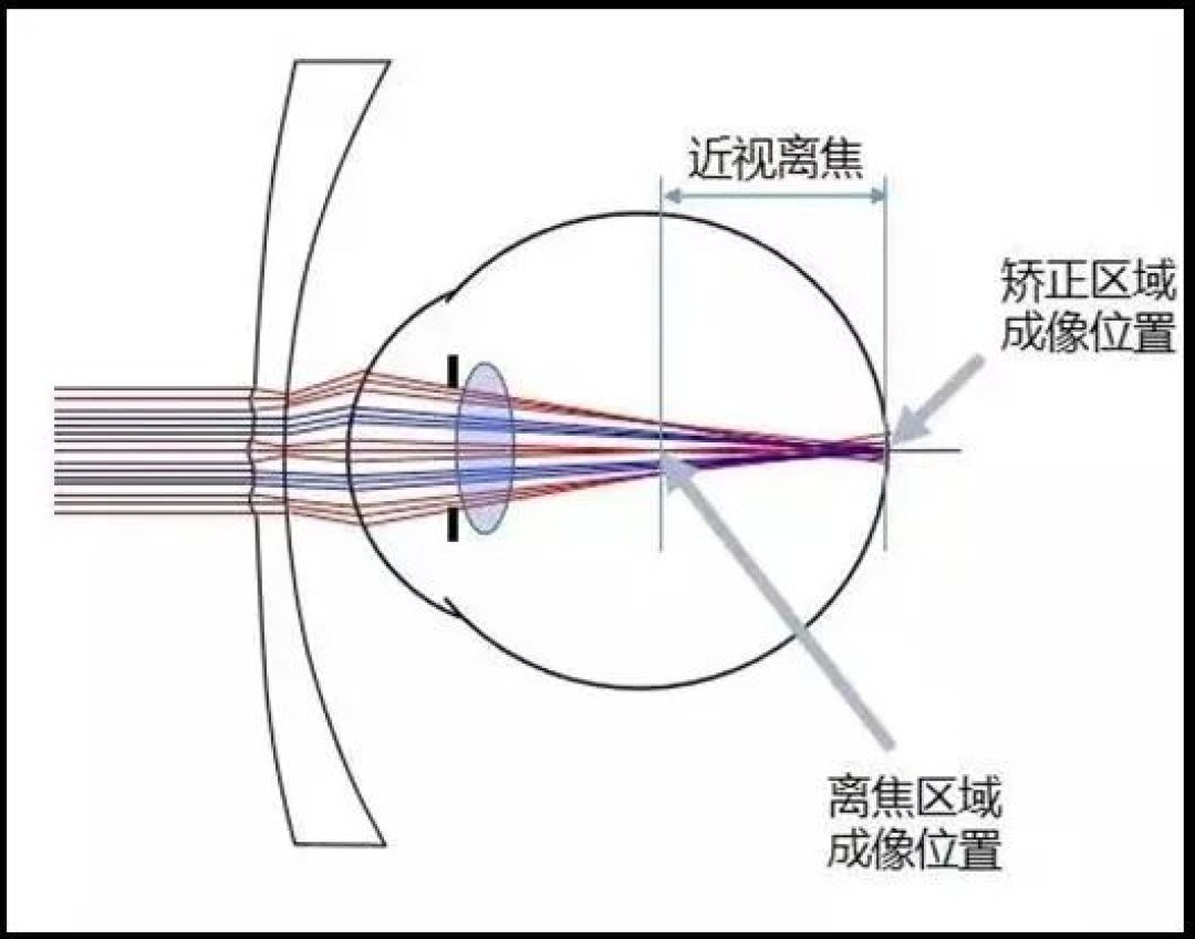 离焦镜,知多少?