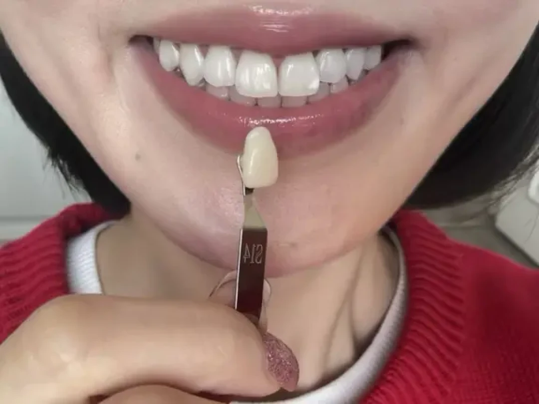 佳洁士美版加强牙贴超详细记录合集