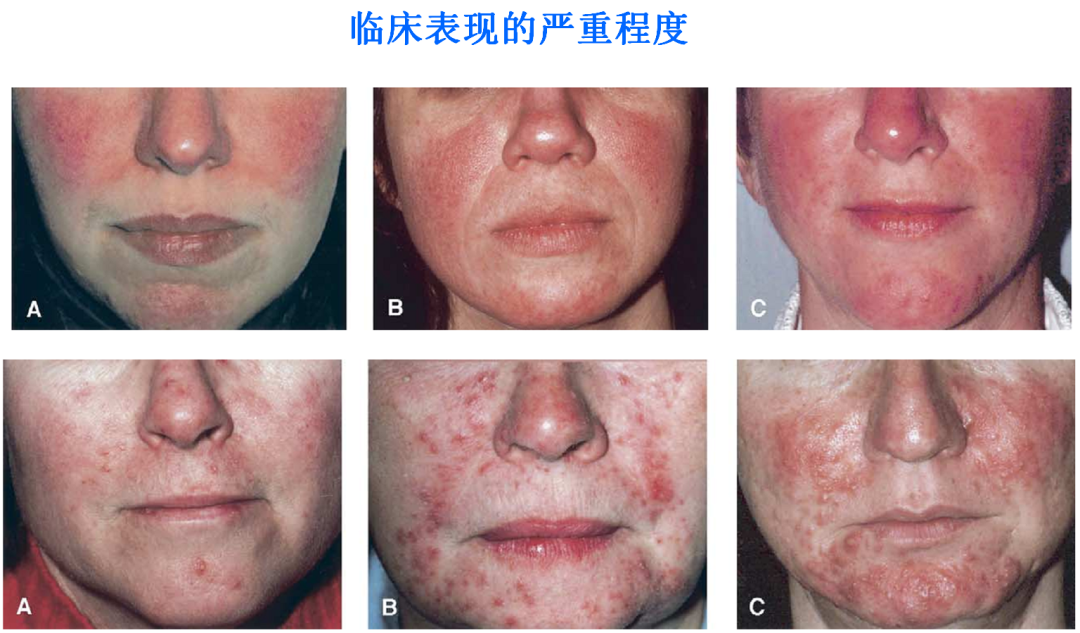 《中国玫瑰痤疮诊疗指南》解读（1）：发病机制、临床表现、诊断与鉴别诊断
