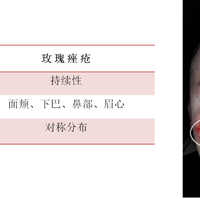《中国玫瑰痤疮诊疗指南》解读（1）：发病机制、临床表现、诊断与鉴别诊断