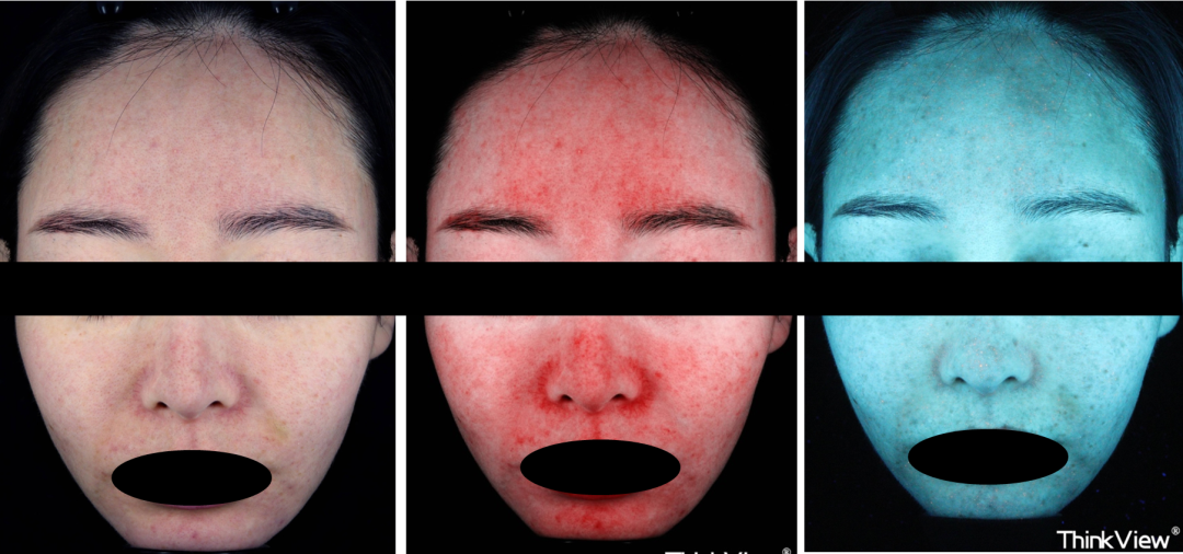 《中国玫瑰痤疮诊疗指南》解读（1）：发病机制、临床表现、诊断与鉴别诊断