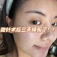 2.5mm微针术后护理攻略 敏肌也能稳稳渡劫