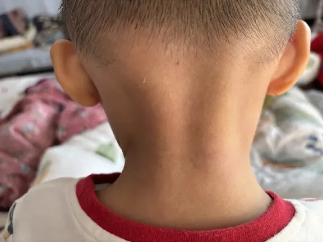 孩子特异性皮炎忌口+补维生素+保湿后续