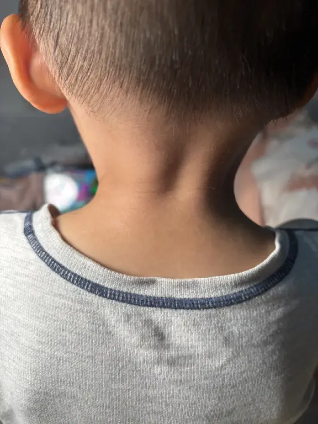 孩子特异性皮炎忌口+补维生素+保湿后续