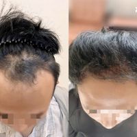 植发案例10 | Hairo植发手术机器人精准施术，助力患者克服8年