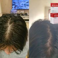 选择内调，我终于告别了脱发还找回了元气满满