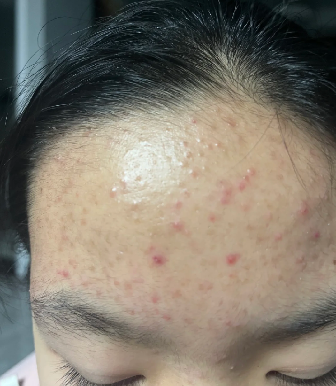 别再乱挤痘!自用4阶段祛痘法,红肿痘→痘印消失全记录...