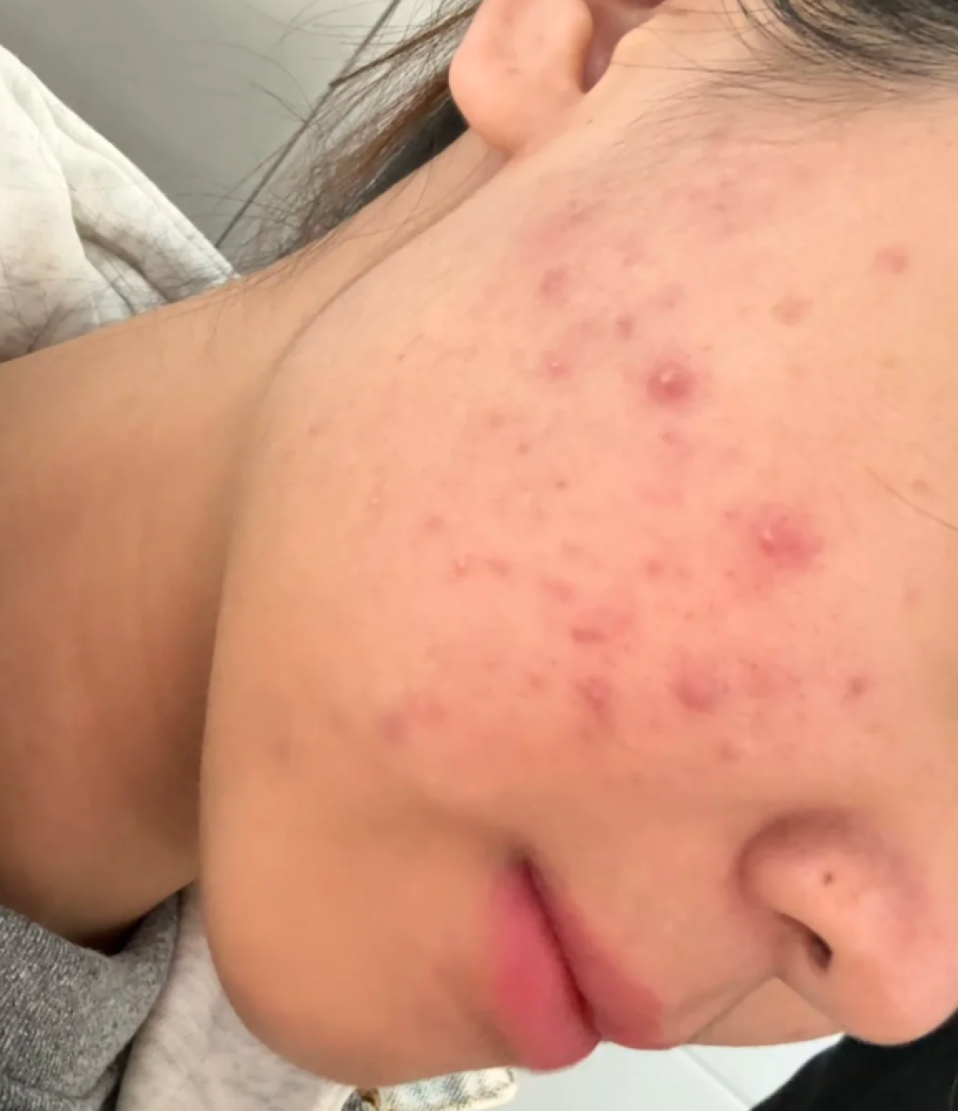 别再乱挤痘!自用4阶段祛痘法,红肿痘→痘印消失全记录...