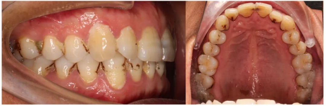 牙齿暗黄染色？一文读懂科学美白，守护笑容健康