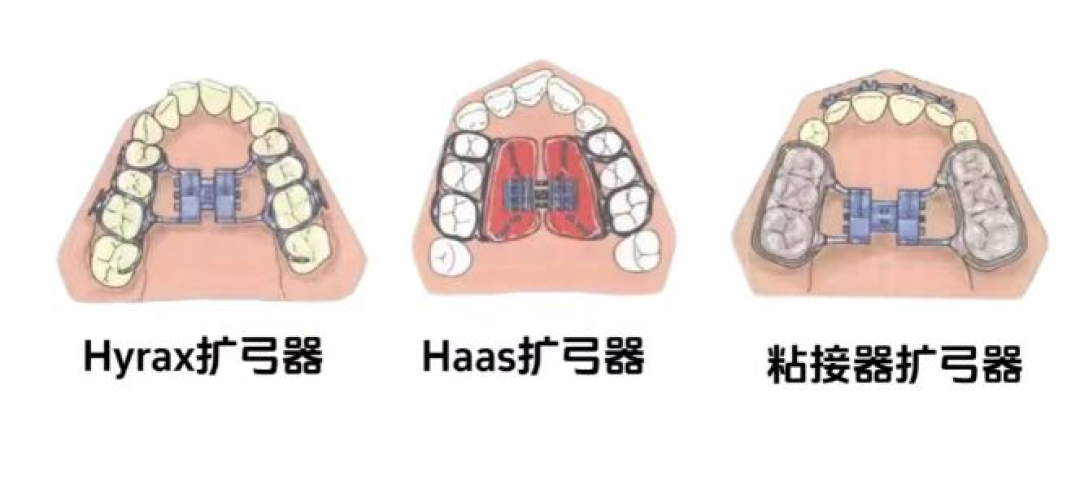 牙齿矫治要趁早!抓住寒假黄金期:别让“牙齿小事”影响孩子未来