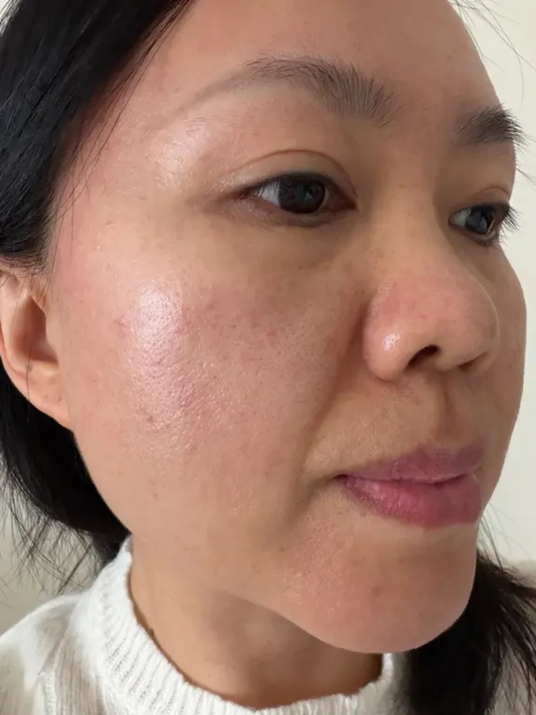 屏障受损,炎症排出来!我终于熬上岸了😹