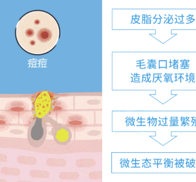 长闭口黑头了，怎么办？