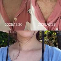 湿疹➕玫瑰糠疹的治疗过程分享……