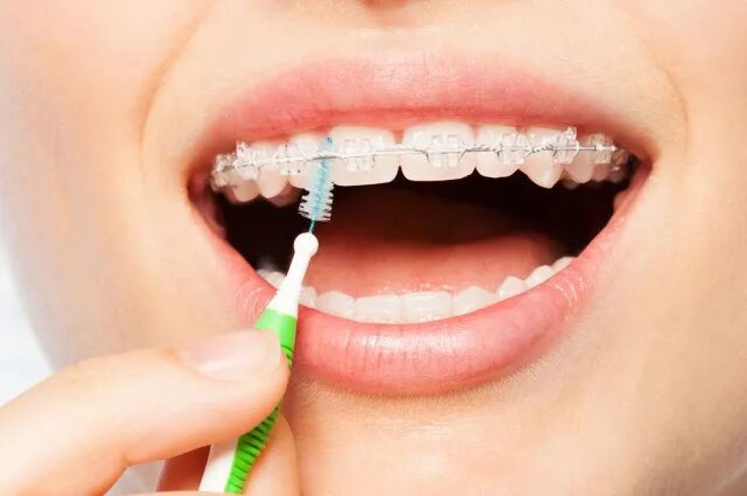 牙医说丨戴牙套该如何做好口腔清洁?