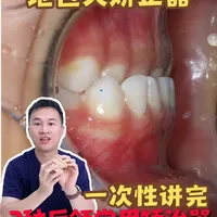 儿童地包天矫正3种常见矫治器该怎么选择?
