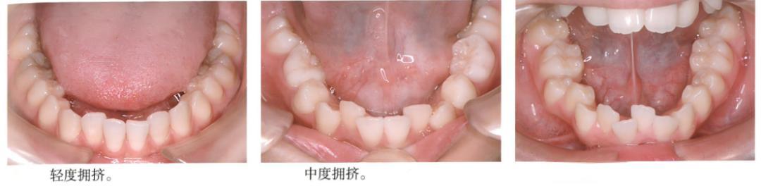 被低估的下颌扩弓:下颌扩弓矫治器创造空间、排齐牙齿、改善咬合的关键手段!