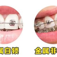 正畸新手必看！劝你别随便牙齿矫正！一张表说清你需不需要矫正+各款牙套价格 + 优缺点对比，附2026成人/儿童牙齿矫正最新价格表