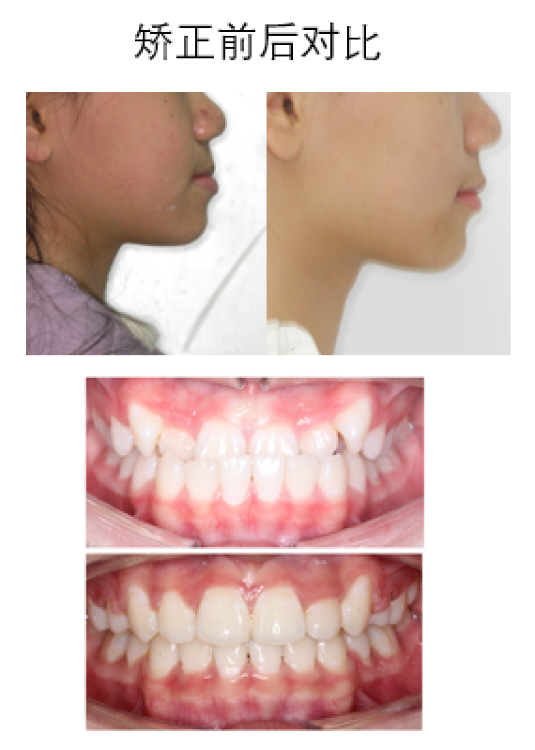 隐形矫正——让您从“齿”轻松拥有自信笑容