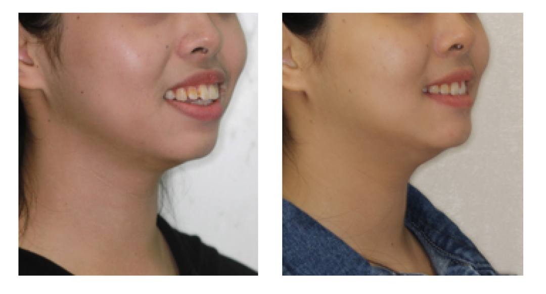 隐形矫正——让您从“齿”轻松拥有自信笑容
