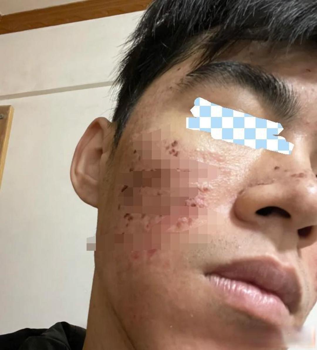 普通男生如何不靠医美低成本改善痘坑?