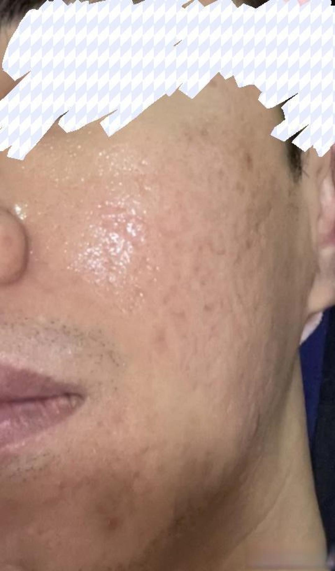 普通男生如何不靠医美低成本改善痘坑?