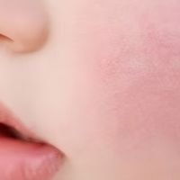 宝宝一到冬天就变“红苹果”？N0，这不是可愛，而是皮肤在求救