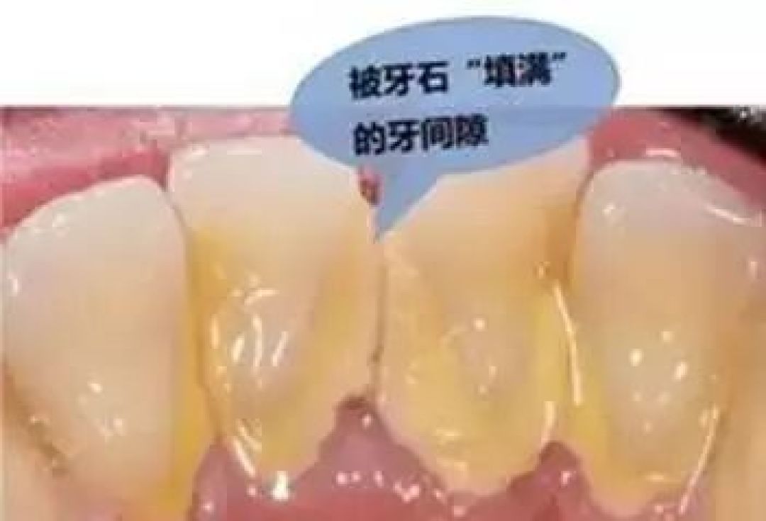 关于 洗牙! 看了就明白，牙医的苦心！！