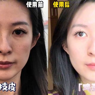 瑕疵皮逆袭！果然好皮肤都是用酸刷出来的